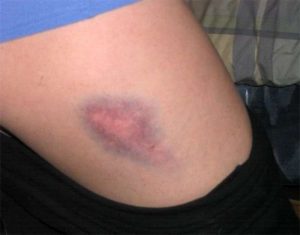 bruise-hematoma-300x235
