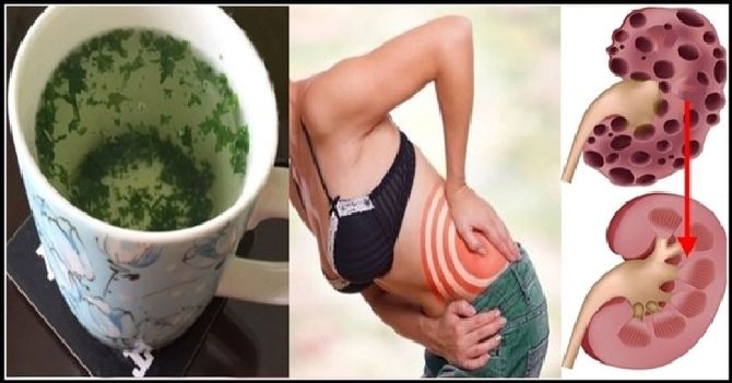 eliminate-kidney-stones-painlessly-with-this-amazing-homemade-remedy_result
