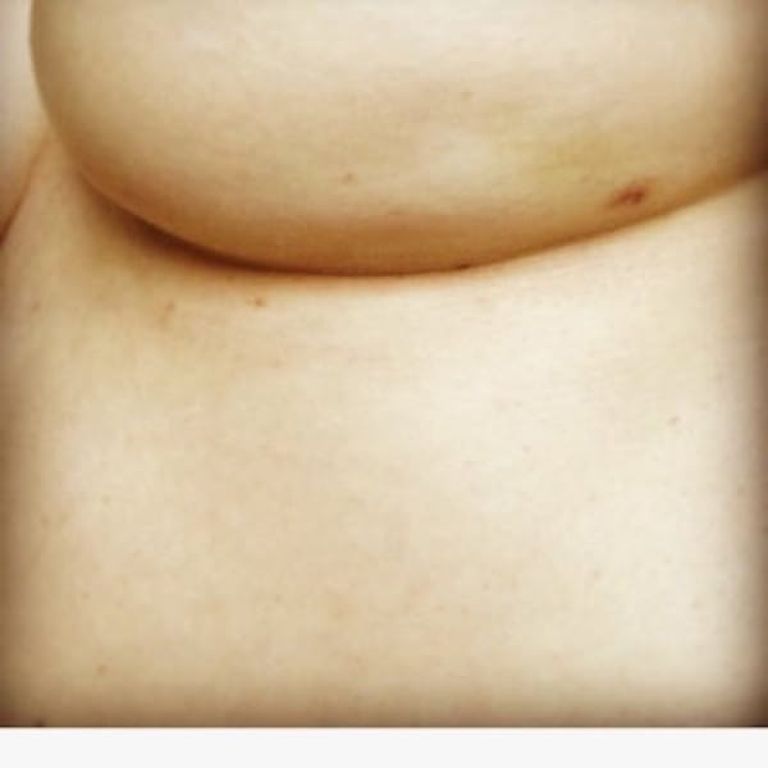 Мама сделала фото странных синяков на груди. Теперь она хочет предупредить всех об их причине