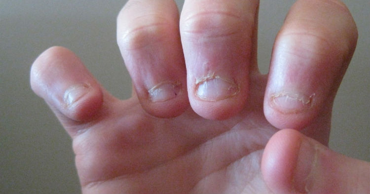 Ученые выяснили, что объединяет людей, которые грызут ногти