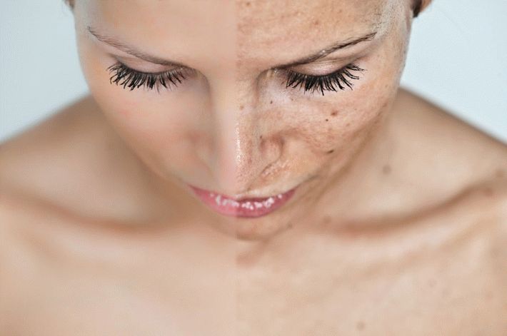 Как убрать и предотвратить пигментные пятна на коже лица и тела