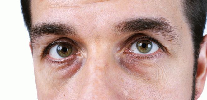 О каких болезнях говорят темные круги под глазами и как от них избавиться