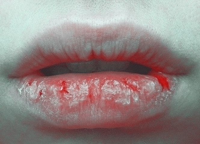Что становится причиной потрескавшихся губ и чем это грозит здоровью