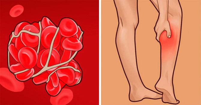Признаки тромбов в кровеносных сосудах