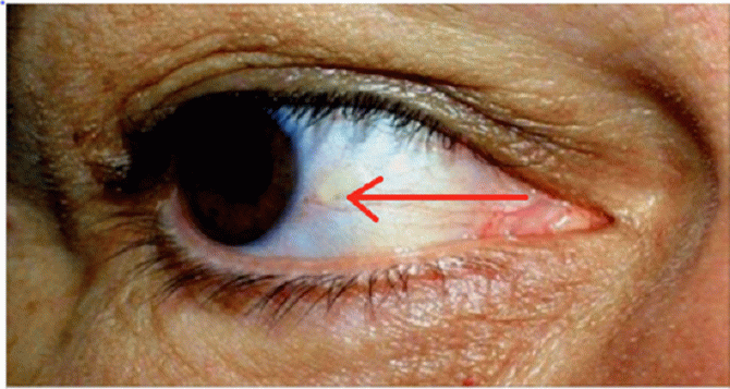 Как глаза предупреждают нас об инфаркте