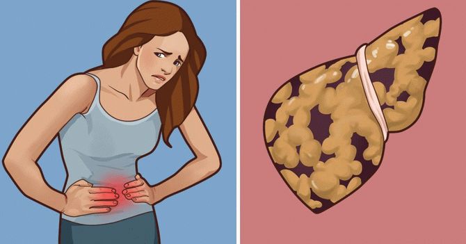 Основные симптомы жировой болезни печени: не допустите цирроз