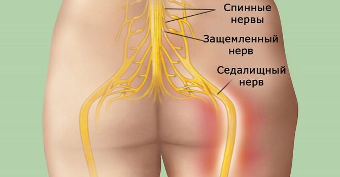 Натуральное средство, которое гарантирует успех лечения боли в спине в 95 % случаев
