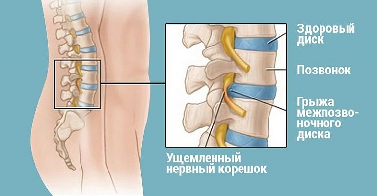 Избавьтесь от спинной грыжи без операции уже через полгода, делая эти простые упражнения