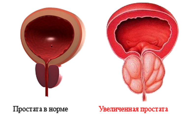 Простатит. Профилактика заболевания