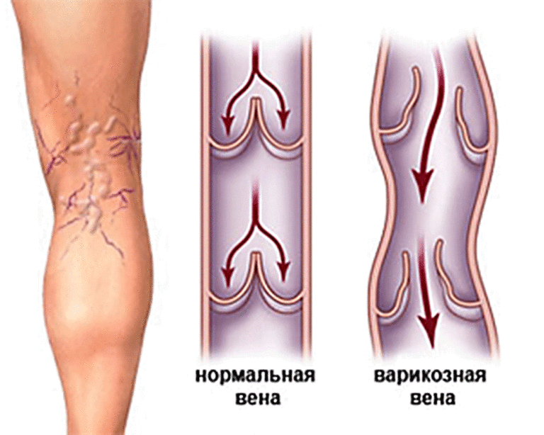 Чтобы кровь «не тормозила». Как избежать варикоза
