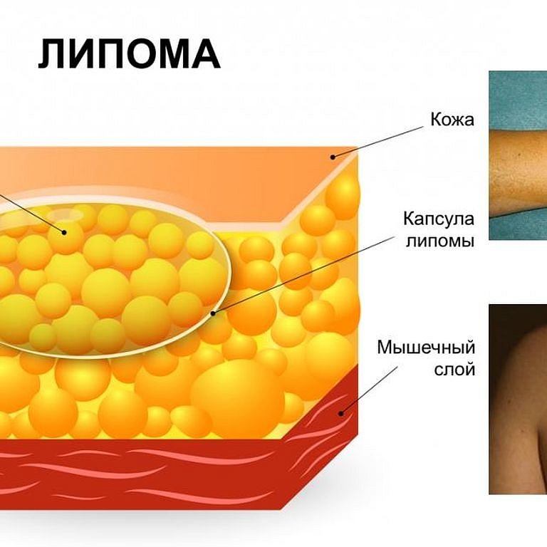 4 народных рецепта для избавления от жировых шариков под кожей