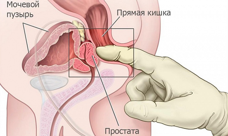 Массаж предстательной железы в домашних условиях