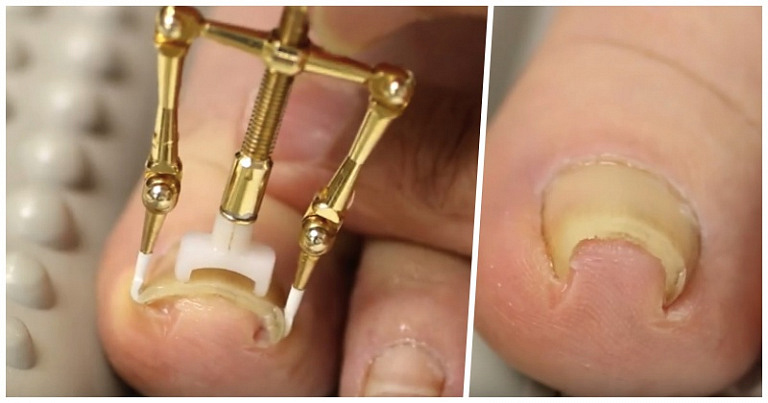 За 30 минут и без боли: в Японии создано простое устройство для лечения вросшего ногтя