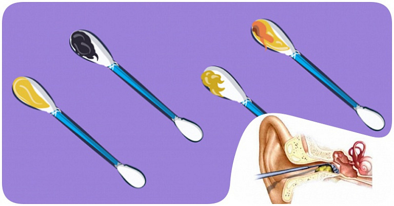 Когда черный цвет к беде: внешний вид ушной серы может многое рассказать о вашем здоровье