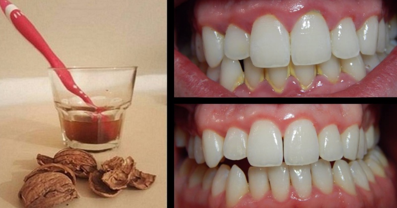 Удаление зубного камня в домашних условиях: поможет скорлупа грецкого ореха