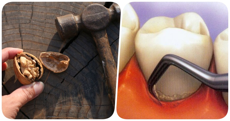 Домашнее средство против зубного камня: доступная каждому профилактика с помощью грецких орехов
