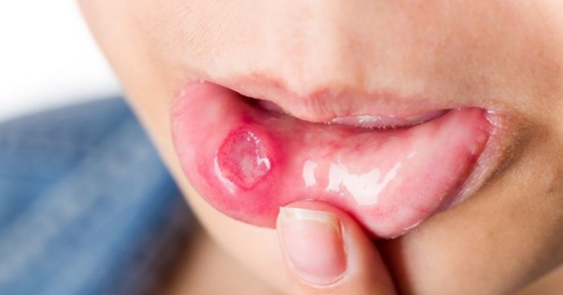 Как надежно избавиться от болезненных ранок и белых пятен во рту