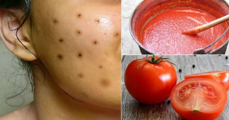 Прыщи и черные точки сбегут от страха: как при помощи обычных помидоров избавиться от проблем с кожей