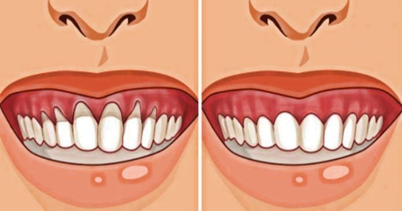 Оголился корень зуба или шейка: лечим и предупреждаем при помощи натуральных средств
