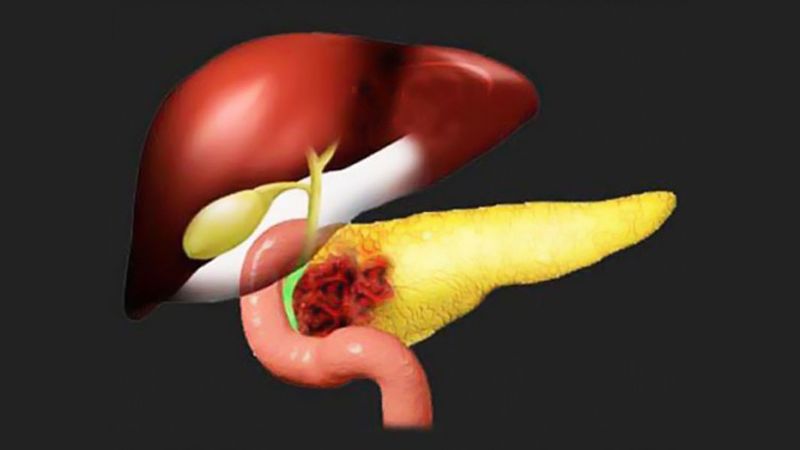 Панкреатит и рак: как выявить ранние симптомы больной поджелудочной железы