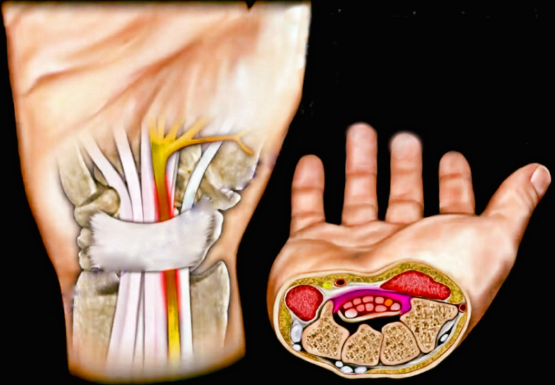 Боль в запястье и онемение пальцев рук: лечимся народными средствами