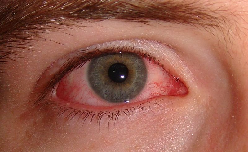 Моргание как самая важная часть лечения: 14 советов экспертов, как избавиться от постоянной сухости глаз