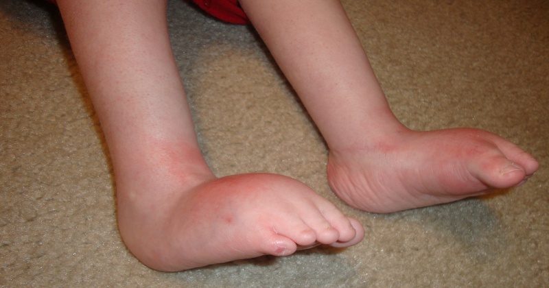 Почему опухают ноги: главные причины и способы лечения хвори