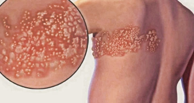 От грибковой инфекции до рака: белые пятна на коже как предвестники серьезных заболеваний