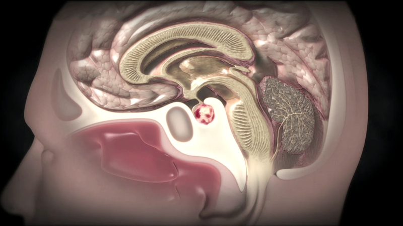 Симптомы, которые помогут вовремя распознать опухоль головного мозга 