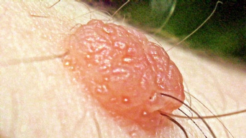 Когда нужно бить тревогу: ранние проявления 3 видов рака кожи