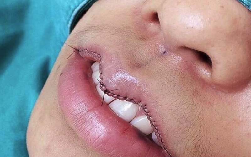 Новый азийский тренд женской красоты: подрезание верхней губы