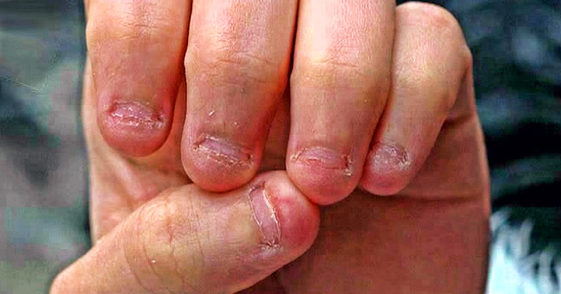 Психологи пришли к выводу, что привычка грызть ногти – яркая черта перфекциониста ...