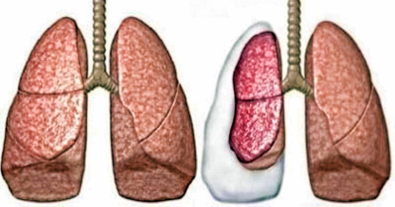 Последствия пневмоторакса лёгких
