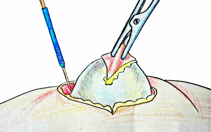 Не рваться к ножу хирурга: вывести жировик поможет тонкая пленка под скорлупой куриного яйца