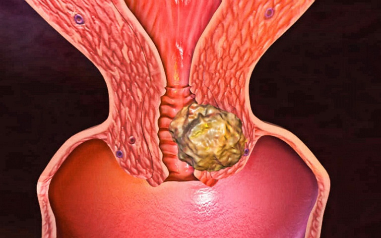 Рак шейки матки: как вовремя заметить, чтобы спастись