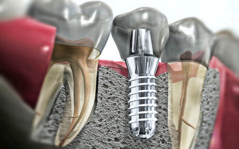 Установка зубных имплантов: что такое и как не дать себя одурачить