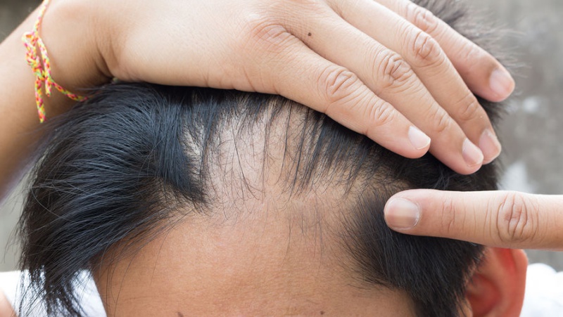 Волосы как предвестник сердечного приступа: как необычно предсказать страшный недуг и сохранить жизнь