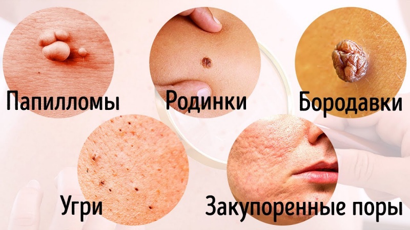 Если заметили непонятные пупырышки: 8 заболеваний, о наличии которых нам подскажет кожа