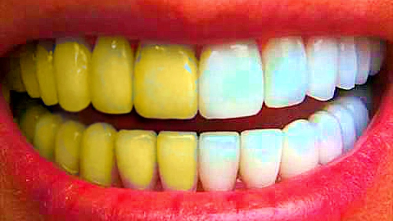 Голливудская улыбка за копейки: простые домашние методы отбеливания зубов