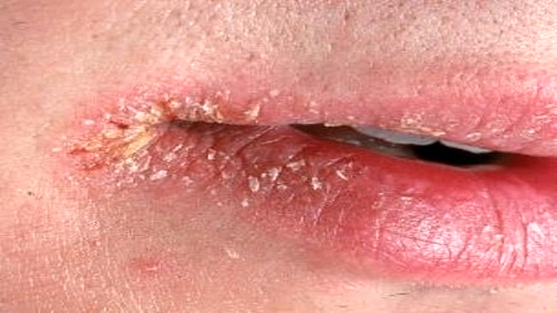 Ангулит: как лечить заеды в уголках губ