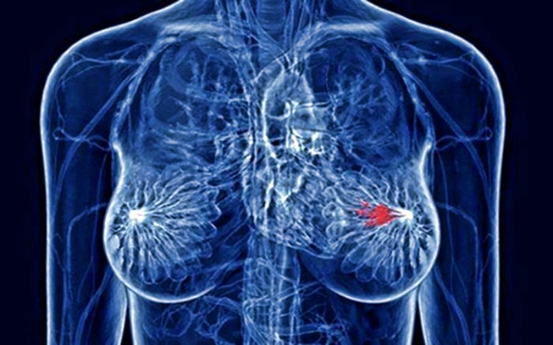 Аспирин в низкой дозировке уменьшает риск заболевания раком груди