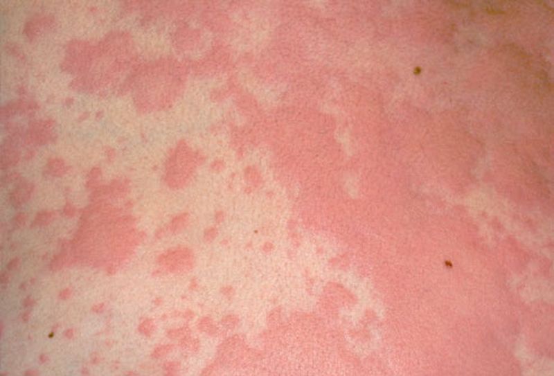 Аллергия на глистов: причины и методы лечения неприятного недуга