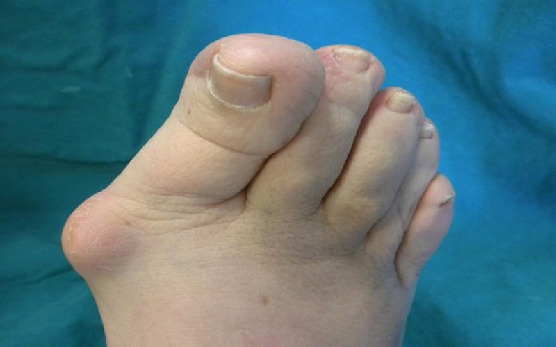 Бурсит большого пальца ноги: причины и методы лечения малоприятной «шишки»