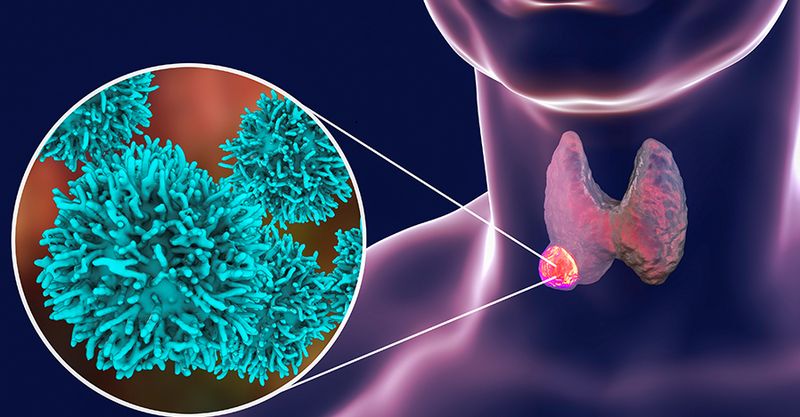 Рак щитовидной железы: симптомы, признаки, стадии, диагностика и лечение