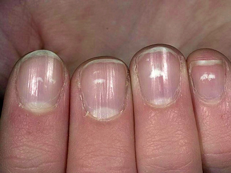 10 заболеваний, которые можно распознать по состоянию ногтей