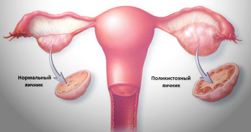 Синдром поликистоза яичников как одна из причин женского бесплодия