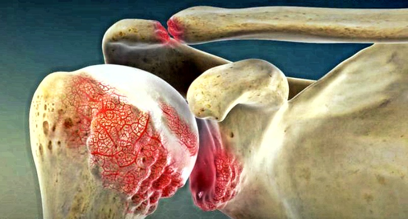 10 верных симптомов артрита: как предупредить страдания в суставах