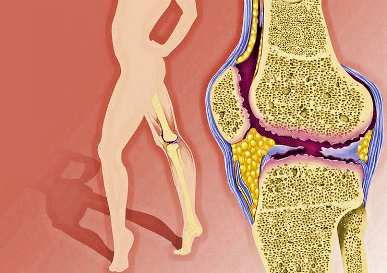 Больные суставы: как распознать первые симптомы остеоартрита