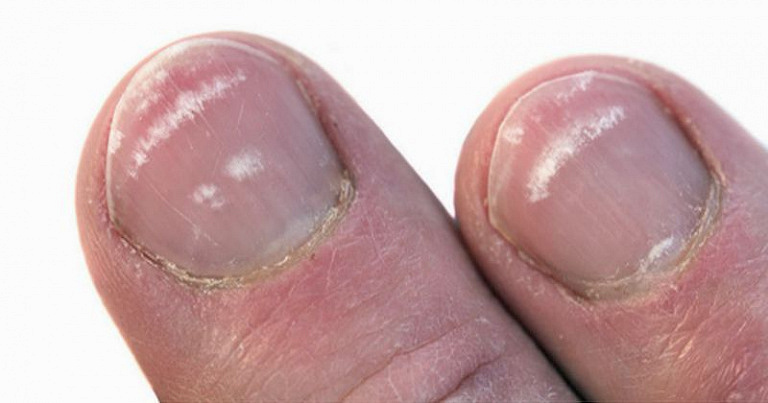 Почему белые полоски на ногтях к беде: ногти как показатель здоровья всего организма