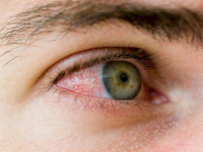 Красные глаза: как избавиться от покраснения при помощи домашних средств